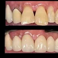 Prothèse dentaire - Cas 4